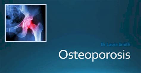 Osteoporosis: assessing the risk of fragility fracture