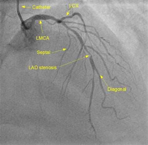 Ostial left anterior descending arteria stenosis treated by