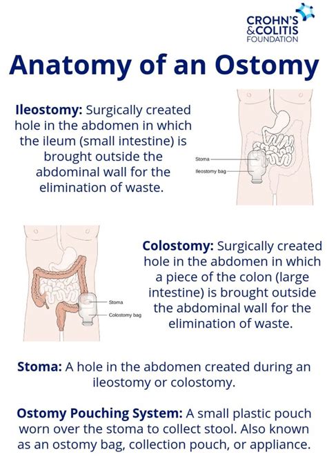 Ostomy surgery Britannica