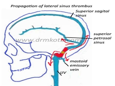 Otogenic Lateral Sinus Thrombosis - Medscape