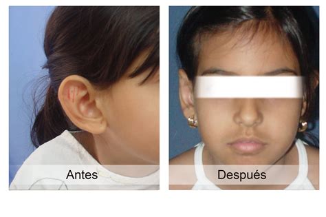 Otoplasty - Dr. Jaime Zapata MD