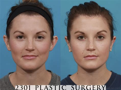 Otoplasty Dallas Ear Surgery Fort Worth - Dr. Rai