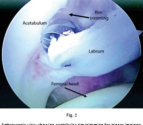 Outcomes following hip arthroscopy for femoroacetabular