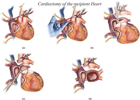 Outcomes of Heart Transplantation in Cardiac …