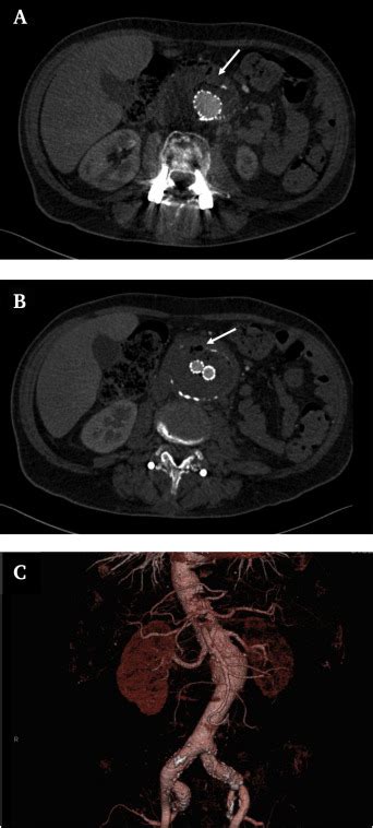 Outcomes of Surgical Explantation of Infected Aortic Grafts After ...