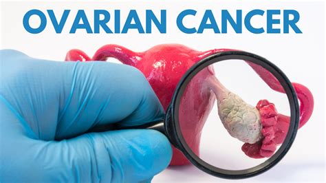 Ovarian cancer: New steps toward early diagnosis