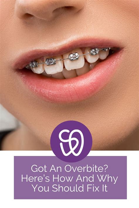 Overbite: Here