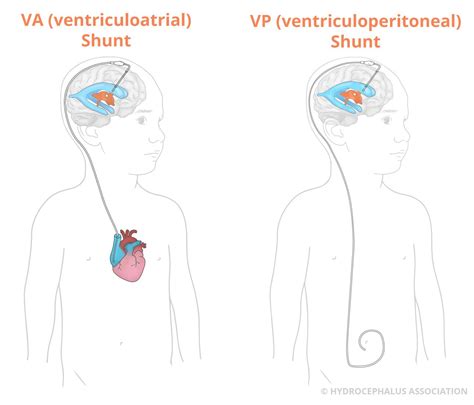 Overdrainage phenomena in shunt treated hydrocephalus