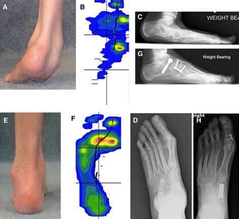 Overview of foot deformity management in children with cerebral …