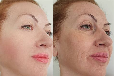 Ozempic face images. Ozempic results in rapid weight loss and does so very effectively. This, of course, will lead to rapid loss of subcutaneous (under the skin) facial fat,’ Dr Sheraz adds. ‘The overlying skin ... 