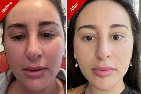 Ozempic face photos. The plastic surgeon told the Times that he treats “Ozempic face” with a deep plane face-lift, which costs $75,000, and a procedure that transfers fat from other parts of the body to the face ... 