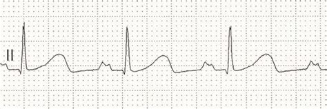 P wave • LITFL • ECG Library Basics