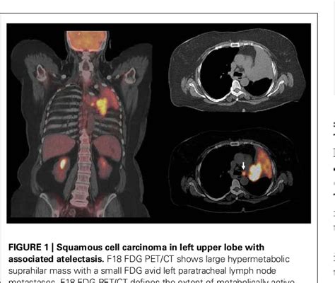 PET CT with Radioactive isotope F18-FDG - InfantRisk Forums