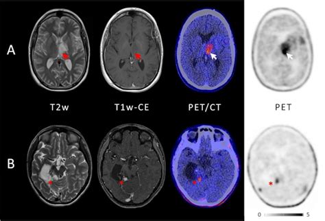 PET Scans: Their Value in the Treatment of Brain Tumors