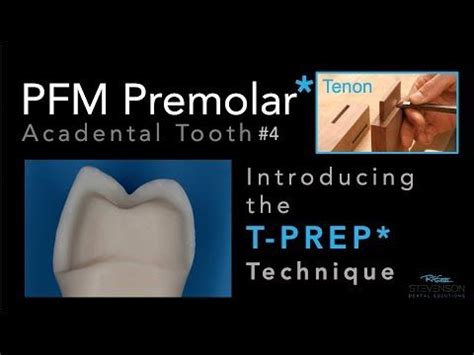 PFM Premolar Using T-PREP Technique Acadental Tooth #4.