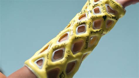 Plaster casts - Perth Children's Hospital - muktibox.com