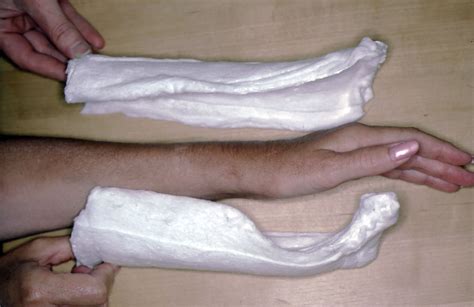 Plaster of Paris: The Forgotten Hand Splinting Material - muktibox.com