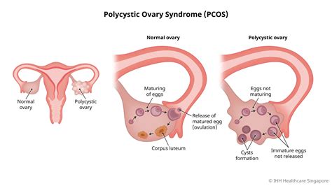 Polycystic ovary syndrome (PCOS) - Symptoms and … - muktibox.com