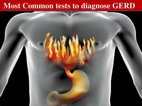 PPT Most Common tests to diagnose GERD PowerPoint Presentation, free