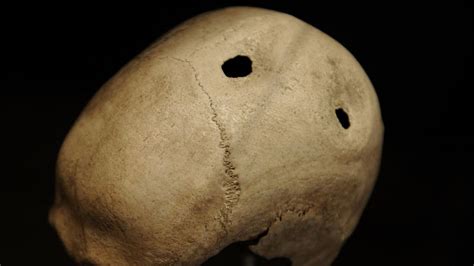 Prehistoric Skull Trepanation in China - ScienceDirect - wintechmobiles.com