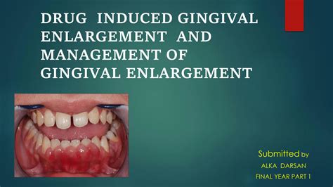 PRIME PubMed Management of medication-induced gingival …