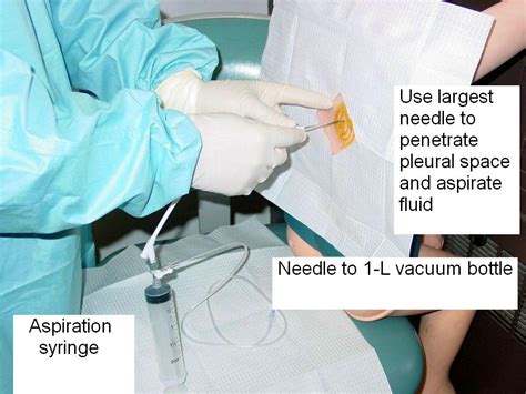 PROCEDURE Thoracentesis (Perform) - Elsevier