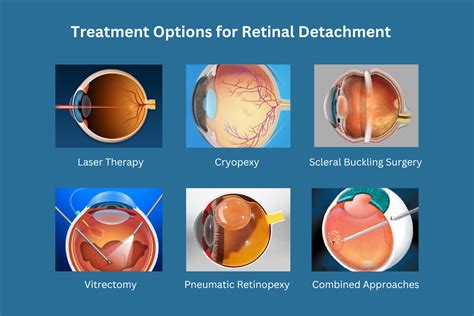 Procedures to Treat Retinal Tears & Retinal Detachments - wintechmobiles.com