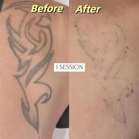 Professional Laser Tattoo Removal of Arabic Script Chest Tattoo - muktibox.com
