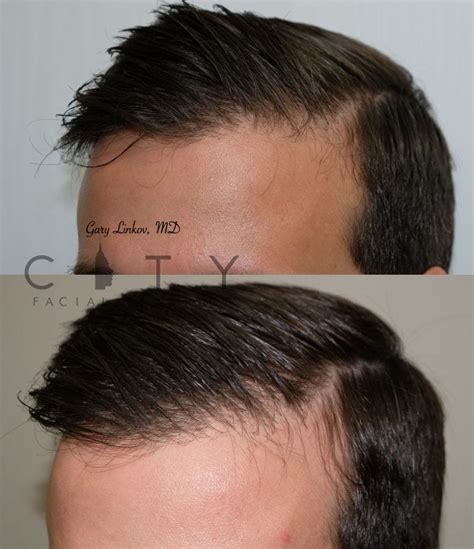 PRP Hair Restoration NYC Hair Loss Treatment in New York