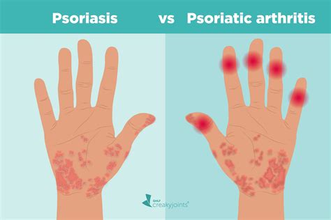 PSA and Tremors - Psoriasis - Inspire