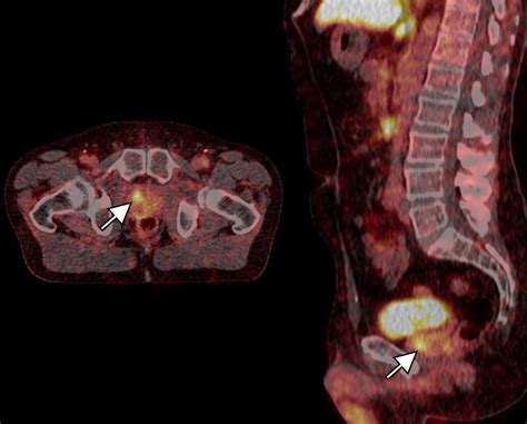 PSMA PET/CT bij prostaatcarcinoom - Richtlijn