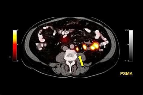 PSMA Scans & Pluvicto (lutetium-177) in 2024 Geoffrey Johnson, MD ...