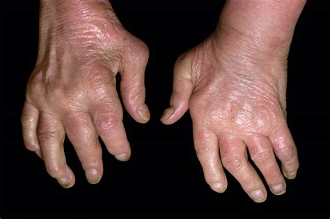 PSORIATISCHE ARTRITIS - Reumaliga