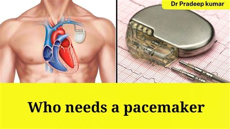 Pacemaker alkohol