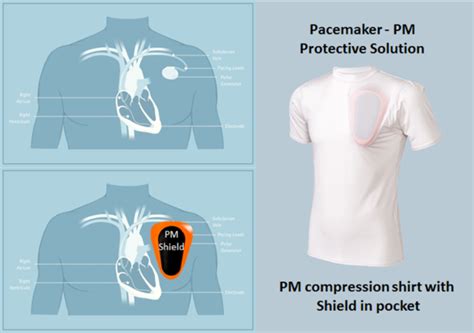 Pacemaker club. Pacemaker Club is an online community for pacemaker, implantable cardioverter defibrillator (ICD) and cardiac resynchronization therapy (CRT) recipients. Contact Us info@pacemakerclub.com 
