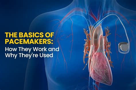 Pacemakers: The Ultimate Guide to Heartbeat Regulation