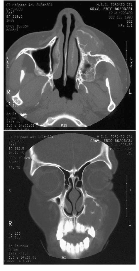 Paediatric aneurysmal bone cysts of the head and neck