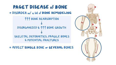 Paget disease of bone: Nursing Osmosis