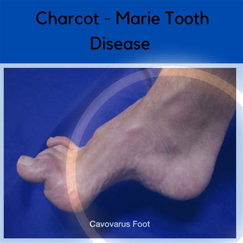 Pain Charcot–Marie–Tooth Association