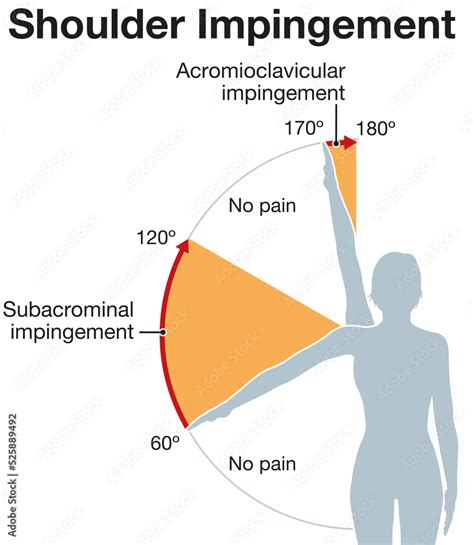 Painful arc - DocCheck Flexikon