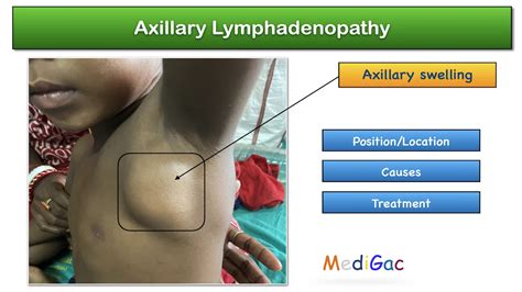 Painful axillary lymphadenopathy.  The most common causes range from com...
