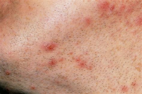 Painful cluster of ingrown hair or other kind skin growth on