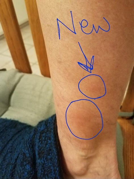Painful lump inside thigh. Call your doctor or 911 if you think you may have a medical emergency. SOC 2 Type 2Certified. i have a hard lump on my inner thigh thought it was a boil and had it about a month now. it is painless ?: Lymph node vs. cyst: … 