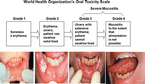 Palliative care - oral: Scenario: Mouth ulcers and mucositis