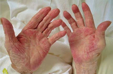 Palmar erythema as a sign of cancer - ccjm.org