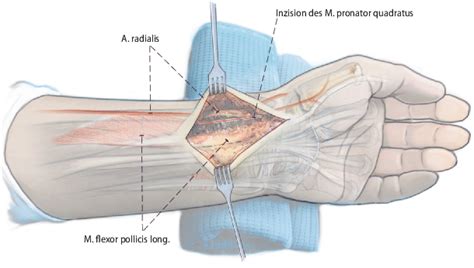 Palmare Plattenosteosynthese in English - German-English …