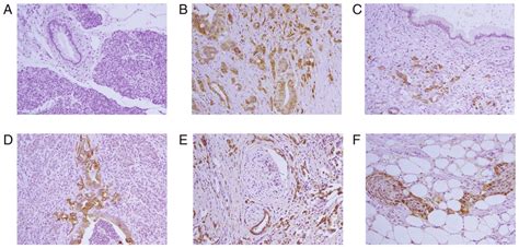 Pancreatic Adenocarcinoma - PMC - National Center for …