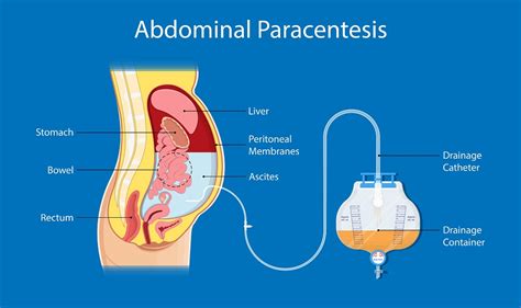 Paracentesis abdominal tap Procedure uses and more