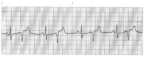 Paramedic Practice Test Cardiology