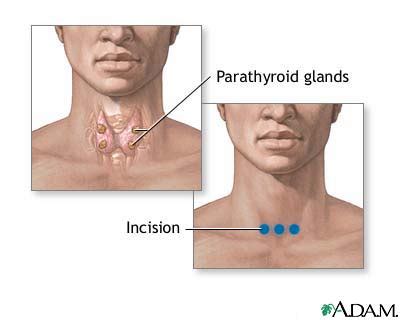 Parathyroid gland removal: MedlinePlus Medical …